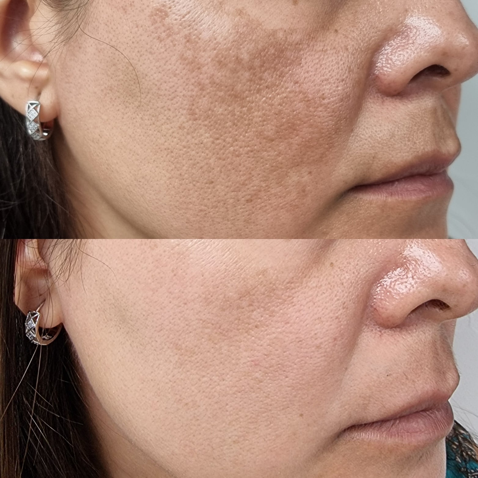 The Ordinary Solución Tónica de Ácido Glicólico 7% para Piel Radiante