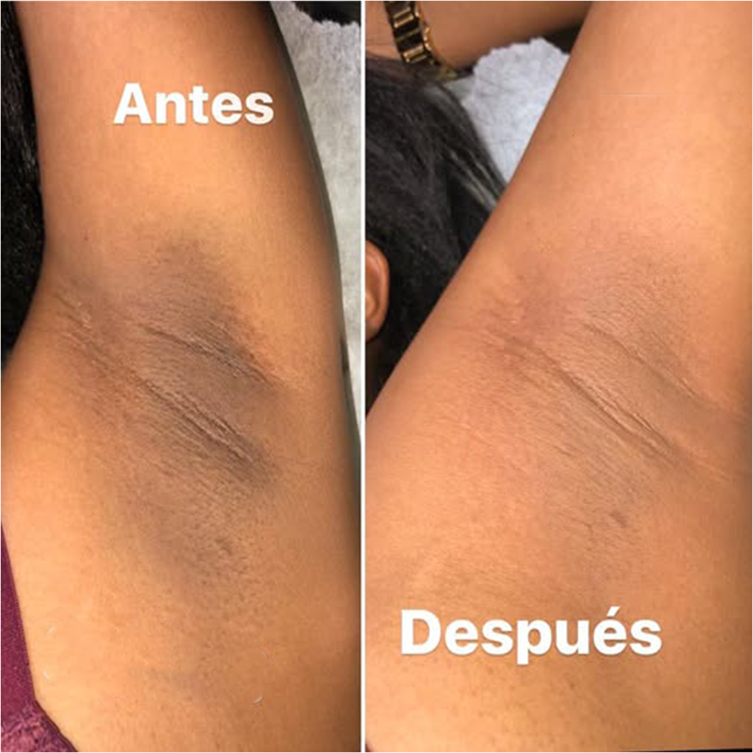 The Ordinary Solución Tónica de Ácido Glicólico 7% para Piel Radiante
