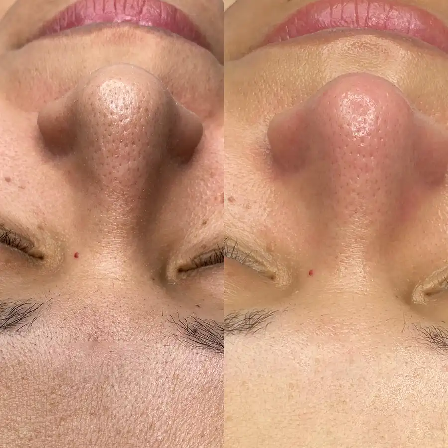 The Ordinary Dúo: Niacinamida + Ácido Salicílico